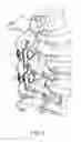 Fig. 05 - Spinous process implants, instruments, and methods