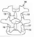 Fig. 01 - SPINOUS FUSION DEVICE
