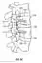 Fig. 19 - Fusion method and pedicle access tool