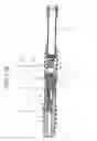 Fig. 28 - Distal interphalangeal fusion device and method of use