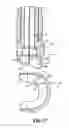 Fig. 11 - Reducing instrument for spinal surgery