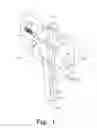 Fig. 02 - Method for implanting a hip fracture nail system