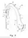 Fig. 03 - Method for implanting a hip fracture nail system