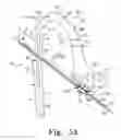 Fig. 05 - Method for implanting a hip fracture nail system