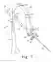 Fig. 08 - Method for implanting a hip fracture nail system