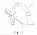 Fig. 13 - Method for implanting a hip fracture nail system