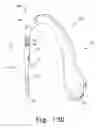 Fig. 15 - Method for implanting a hip fracture nail system