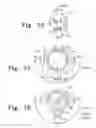 Fig. 16 - Method for implanting a hip fracture nail system