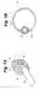 Fig. 02 - Method and apparatus for retaining medical implants within body vessels