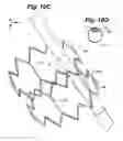 Fig. 14 - Method and apparatus for retaining medical implants within body vessels