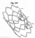 Fig. 16 - Method and apparatus for retaining medical implants within body vessels
