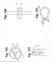 Fig. 17 - Method and apparatus for retaining medical implants within body vessels