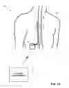 Fig. 02 - Dorsal column stimulation therapy
