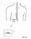 Fig. 03 - Dorsal column stimulation therapy