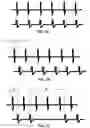 Fig. 09 - Dorsal column stimulation therapy