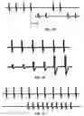 Fig. 10 - Dorsal column stimulation therapy