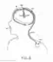 Fig. 06 - Methods to avoid frequency locking in a multi-channel neurostimulation system using pulse shifting