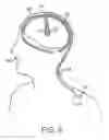 Fig. 06 - Methods to avoid frequency locking in a multi-channel neurostimulation system using pulse placement