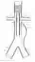Fig. 01 - APPARATUS AND METHOD OF PLACEMENT OF A GRAFT OR GRAFT SYSTEM