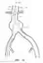 Fig. 16 - APPARATUS AND METHOD OF PLACEMENT OF A GRAFT OR GRAFT SYSTEM