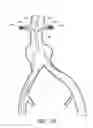 Fig. 17 - APPARATUS AND METHOD OF PLACEMENT OF A GRAFT OR GRAFT SYSTEM