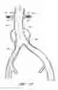 Fig. 19 - APPARATUS AND METHOD OF PLACEMENT OF A GRAFT OR GRAFT SYSTEM