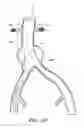 Fig. 20 - APPARATUS AND METHOD OF PLACEMENT OF A GRAFT OR GRAFT SYSTEM