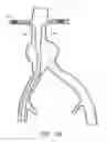 Fig. 25 - APPARATUS AND METHOD OF PLACEMENT OF A GRAFT OR GRAFT SYSTEM