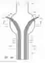 Fig. 28 - APPARATUS AND METHOD OF PLACEMENT OF A GRAFT OR GRAFT SYSTEM
