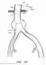 Fig. 48 - APPARATUS AND METHOD OF PLACEMENT OF A GRAFT OR GRAFT SYSTEM