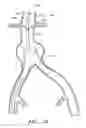 Fig. 16 - APPARATUS AND METHOD OF PLACEMENT OF A GRAFT OR GRAFT SYSTEM