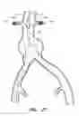 Fig. 17 - APPARATUS AND METHOD OF PLACEMENT OF A GRAFT OR GRAFT SYSTEM