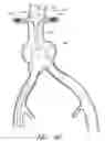 Fig. 18 - APPARATUS AND METHOD OF PLACEMENT OF A GRAFT OR GRAFT SYSTEM