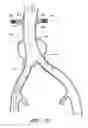 Fig. 19 - APPARATUS AND METHOD OF PLACEMENT OF A GRAFT OR GRAFT SYSTEM