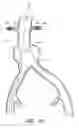 Fig. 20 - APPARATUS AND METHOD OF PLACEMENT OF A GRAFT OR GRAFT SYSTEM