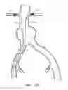 Fig. 24 - APPARATUS AND METHOD OF PLACEMENT OF A GRAFT OR GRAFT SYSTEM