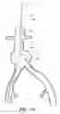 Fig. 41 - APPARATUS AND METHOD OF PLACEMENT OF A GRAFT OR GRAFT SYSTEM