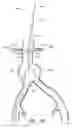 Fig. 43 - APPARATUS AND METHOD OF PLACEMENT OF A GRAFT OR GRAFT SYSTEM