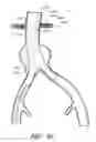 Fig. 48 - APPARATUS AND METHOD OF PLACEMENT OF A GRAFT OR GRAFT SYSTEM
