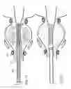 Fig. 14 - Implantable medical devices