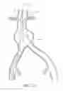 Fig. 16 - Fenestrated prosthesis