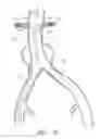 Fig. 19 - Fenestrated prosthesis