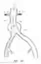 Fig. 20 - Fenestrated prosthesis