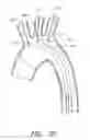 Fig. 22 - Fenestrated prosthesis