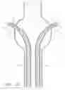 Fig. 30 - Fenestrated prosthesis