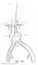 Fig. 43 - Fenestrated prosthesis