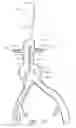 Fig. 44 - Fenestrated prosthesis