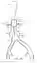 Fig. 45 - Fenestrated prosthesis