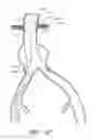 Fig. 48 - Fenestrated prosthesis