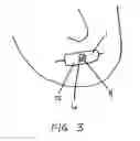 Fig. 03 - Sealing nasal devices for use while sleeping